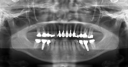 インプラント症例CT