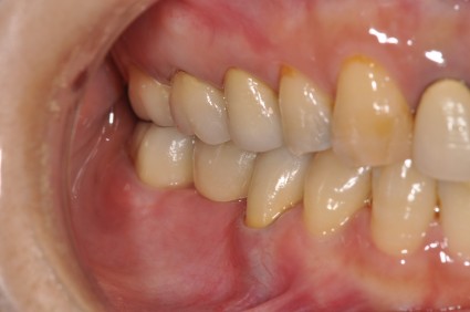 インプラント治療症例